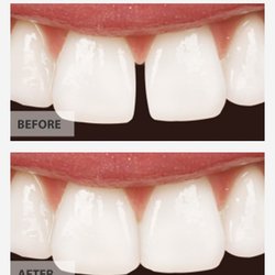 Dental bridges Clifton Park