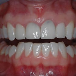 Precision Arts Dental Associates - Patient had these veneers done 3 times prior to coming to my practice!