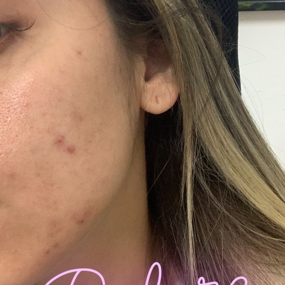 Evolve Skin + Wellness - Before - Skin Care Near Me - Pasadena, California Evolve Skin + Wellness - Before - Skin Care Near Me - Pasadena, California