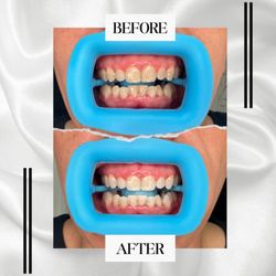 Flawless Figure Sculpting - Teeth Whitening