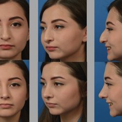 Aaron Kosins, MD - Primary septorhinoplasty in a girl with a plunging tip on smiling.