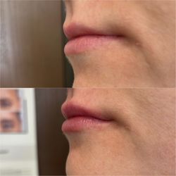 Aspen Aesthetics & wellness - Beautiful subtle lip transformation using juverderm !