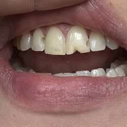 Brookshire Dentistry - Before picture of my teeth!