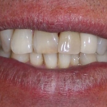 David P Blanco, DDS - Patient B Before - Cosmetic Dentists Near Me - Salt Lake City, Utah David P Blanco, DDS - Patient B Before - Cosmetic Dentists Near Me - Salt Lake City, Utah