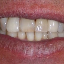 David P Blanco, DDS - Patient B Before