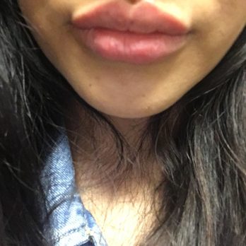 Plush Derma - Day one - Laser Hair Removal Near Me - El Monte, California Plush Derma - Day one - Laser Hair Removal Near Me - El Monte, California