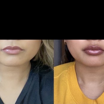 Usha Rajagopal, MD - Botox for the jaw to relieve TMJ. The pictures are 4 months apart. The results speak for themselves!!! - Cosmetic Surgeons Near Me - San Francisco, California Usha Rajagopal, MD - Botox for the jaw to relieve TMJ. The pictures are 4 months apart. The results speak for themselves!!! - Cosmetic Surgeons Near Me - San Francisco, California