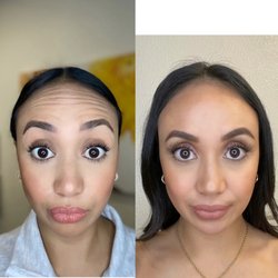 Before and after of forehead wrinkles