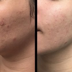 Beautify By Karin - Before and after - one session of Microneedling with PRP