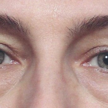 Marina Plastic Surgery - Upper lid before - Medical Spas Near Me - Los Angeles, California Marina Plastic Surgery - Upper lid before - Medical Spas Near Me - Los Angeles, California