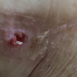 Seaview Orthopaedics - Another photo of the lead popping out of the hole.