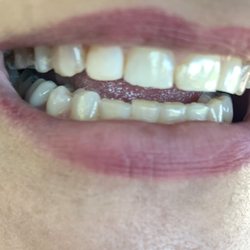 Kalogiannis Mike DMD DDS - Dr. Mike fixed my chipped tooth! Yay!!