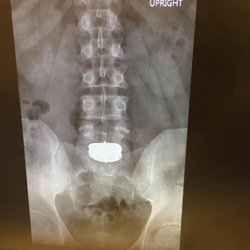 Kaweah Health - Exeter - Post disc replacement