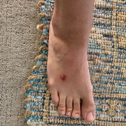 My foot injury
