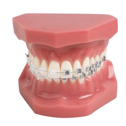 Altherr Orthodontics - Model with clear and metal braces