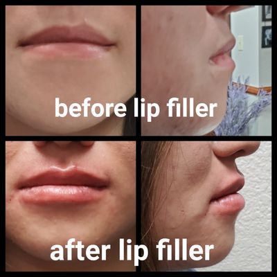 Lip Filler - Multiple clients that had lip filler with amazing results. Lip Filler - Multiple clients that had lip filler with amazing results.