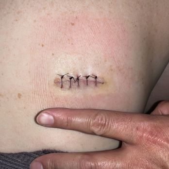 Salt & Light Wellness - Basal Cell Carcinoma surgical excision - Saunas Near Me - Temecula, California Salt & Light Wellness - Basal Cell Carcinoma surgical excision - Saunas Near Me - Temecula, California