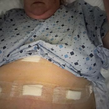 Medical Mex - My incisions - Plastic Surgeons Near Me