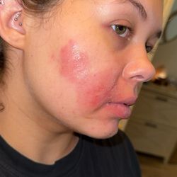 Conejo Dermatology - Resistant Bacterial infection.