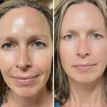 Rose And Thorn Day Spa - Ultherape XT Facelift and Necklift - Skin Care Near Me - Wheat Ridge, Colorado Rose And Thorn Day Spa - Ultherape XT Facelift and Necklift - Skin Care Near Me - Wheat Ridge, Colorado