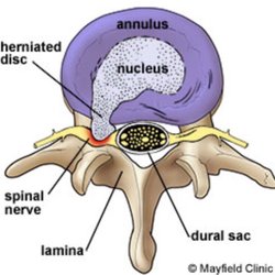 BowenWorks for Healing - Herniated disc top view.