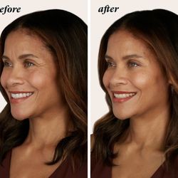 Bella Grey Medical Spa - Before and after photos of a woman who received Botox injections