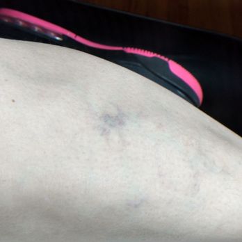 DC Electrolysis - Before electrolysis treatment - Laser Hair Removal Near Me - Canton, Michigan DC Electrolysis - Before electrolysis treatment - Laser Hair Removal Near Me - Canton, Michigan