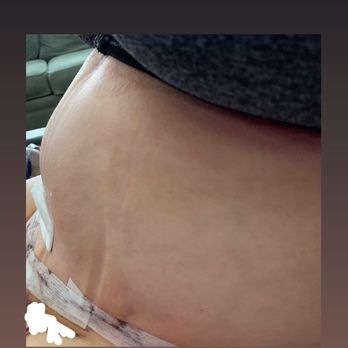 Advanced Surgical Institute - Hours after tummy tuck with DR. HAKEEM. Bulge above belly button. - Cosmetic Surgeons Near Me - Rancho Cucamonga, California Advanced Surgical Institute - Hours after tummy tuck with DR. HAKEEM. Bulge above belly button. - Cosmetic Surgeons Near Me - Rancho Cucamonga, California