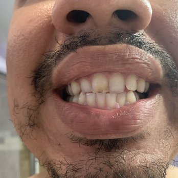 Alpha Dental Care - Before - Orthodontists Near Me - Fullerton, California