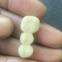 Jefferson Dental & Orthodontics - Wallisville - Bridge built by Jefferson dental which lost adhesive and they said they can't put it back in without an exam.