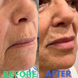 Jessica Plotnick,PA PC -CPW Vein & Aesthetic Center - Lip filler & downturned mouth. 2 syringes used. Lasts up to 1 year.