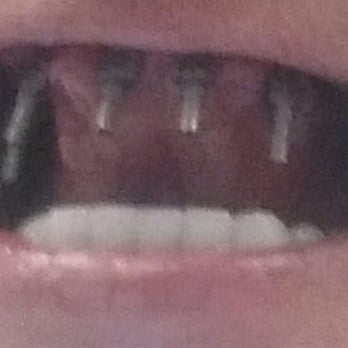 Delaune Dental - $12,825 CASH No refund given per Delaunes email. Picture taken 8-2016 Paid 8-2015 - Cosmetic Dentists Near Me - Metairie, Louisiana