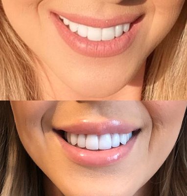 Lips - Before and after photos of lip transformations. Lips - Before and after photos of lip transformations.
