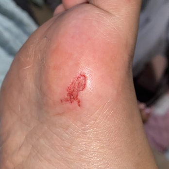 Cloud Nail Spa  - after coming home and cleaning the wound - Nail Salons Near Me - San Diego, California