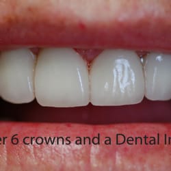 Adam M Hogan, DDS - Dental Implants and Crowns restored by Dr. Hogan.