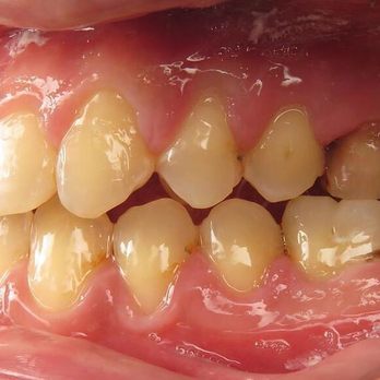 Phan Orthodontics - No more crossbite! - Orthodontists Near Me - San Jose, California