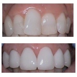 Downers Dental - Cosmetic Veneers and gun surgery