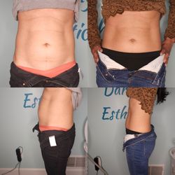 Darling Esthetics - Body contouring