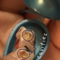 Superior Family Dental - Teeth that had to be extracted from 8 year old after years of regular exams at SFD