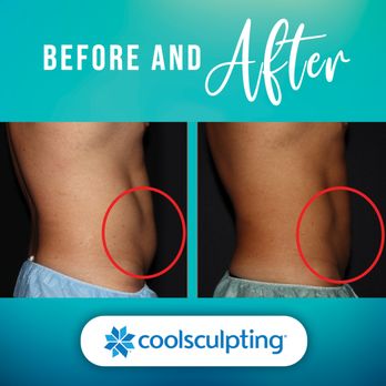 Bodenvy CoolSculpting & Weight Loss Tulsa - Get rid of the belly fat excess with CoolSculpting Elite at Bodenvy Tulsa! - Medical Spas Near Me - Tulsa, Oklahoma Bodenvy CoolSculpting & Weight Loss Tulsa - Get rid of the belly fat excess with CoolSculpting Elite at Bodenvy Tulsa! - Medical Spas Near Me - Tulsa, Oklahoma