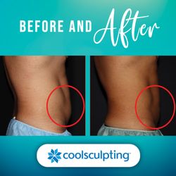 Bodenvy CoolSculpting & Weight Loss Tulsa - Get rid of the belly fat excess with CoolSculpting Elite at Bodenvy Tulsa!