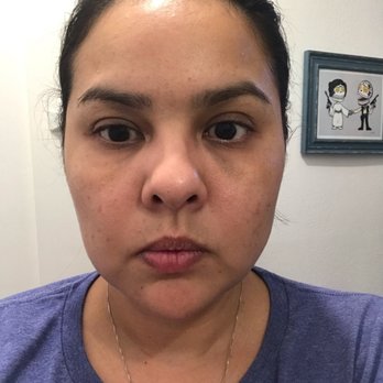 Skin Deep Laser Medspa - Tyndall Effect Under Both Eyes - Skin Care Near Me - Pasadena, California Skin Deep Laser Medspa - Tyndall Effect Under Both Eyes - Skin Care Near Me - Pasadena, California