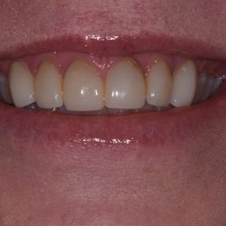 Mark Arooni, DDS - Lakeview Dental - A revision case. Replaced 10 old crowns to create, more natural, broader smile.