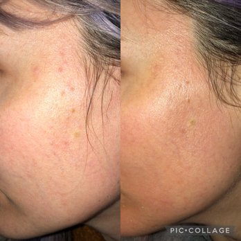 Glow DermSolutions - Left - before; right - after - Medical Spas Near Me - San Jose, California Glow DermSolutions - Left - before; right - after - Medical Spas Near Me - San Jose, California