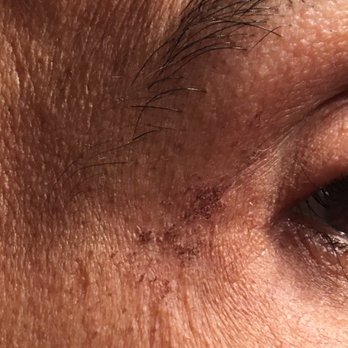 European Wax Center - scars get flaky, hope they get fadded - Waxing Near Me - Silver Spring, Maryland European Wax Center - scars get flaky, hope they get fadded - Waxing Near Me - Silver Spring, Maryland