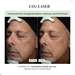 Laguna Med Spa - Before and after photos of CO2 laser treatment