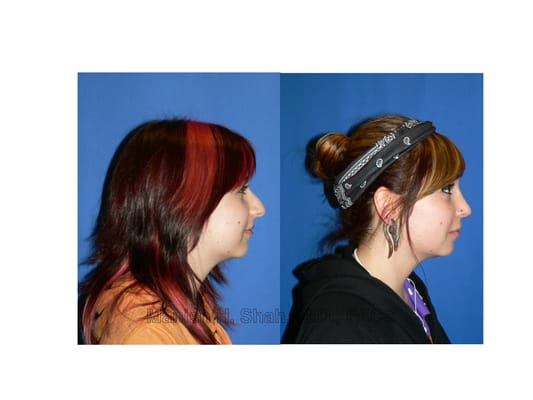 Shah Aesthetic Surgery - Rhinoplasty and Facelift Specialist by null