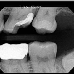 Associated Dentists - X-Ray of the temporary seal before the crown is placed.