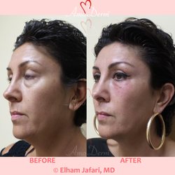 Amoderm Cosmetic & Wellness Medical Center - 4D Under Eye Lift - Treatment of dark circles & bags under eyes and cheek restoration with Belotero, Restylane, Volbella and Voluma