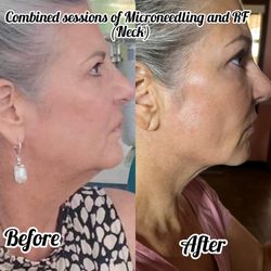 Bellissimo You - RF Microneedling to tighten up neck
